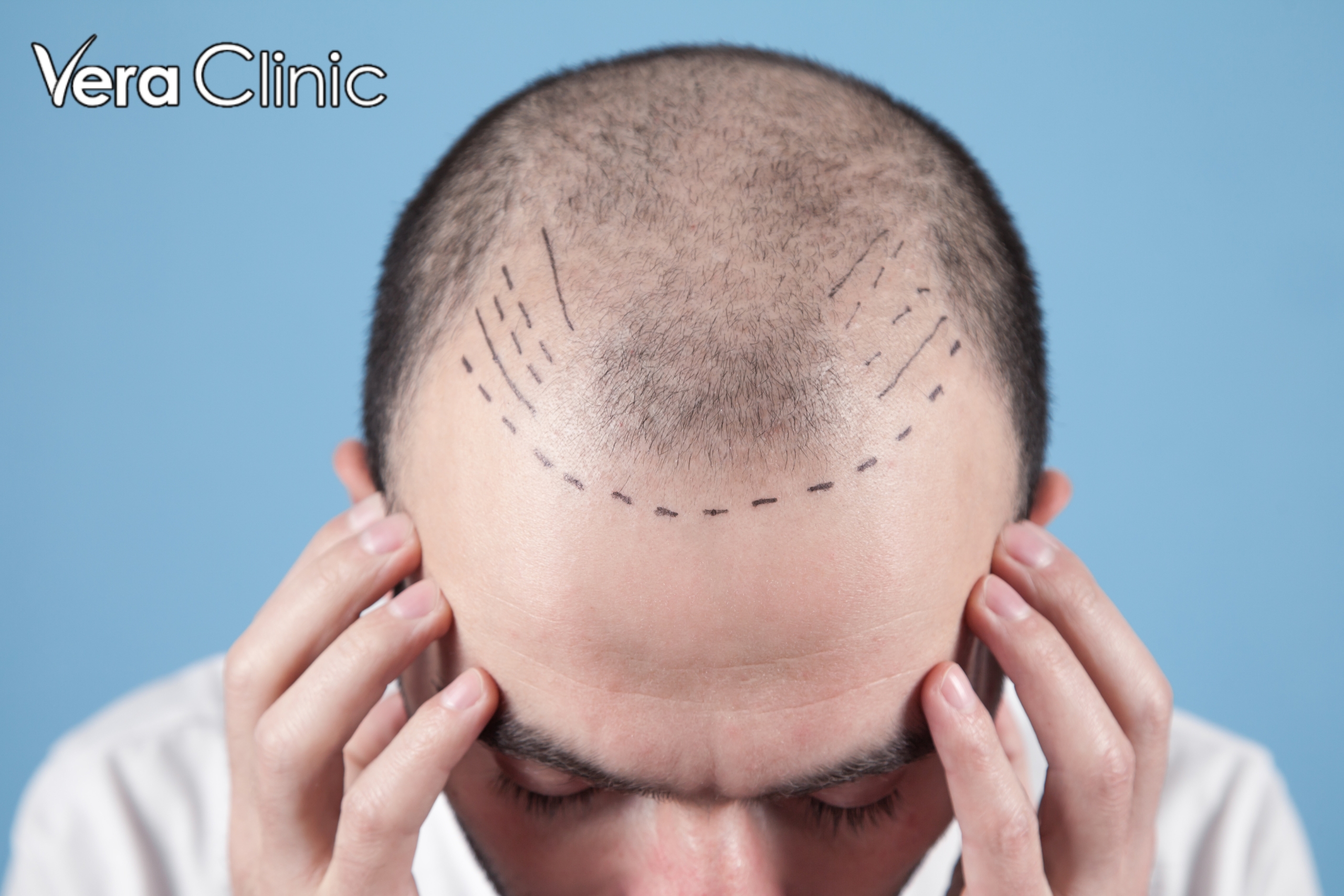 turkey hair transplant